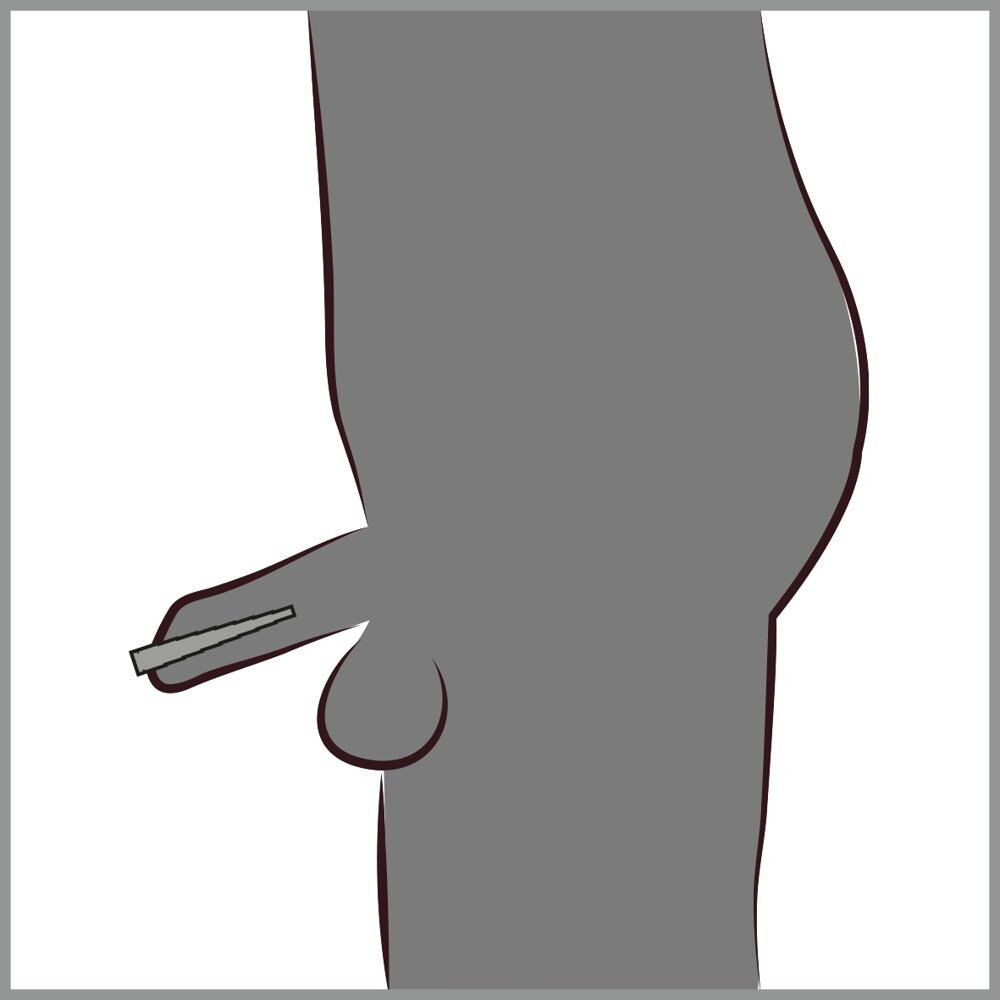 Stepped Dilator
