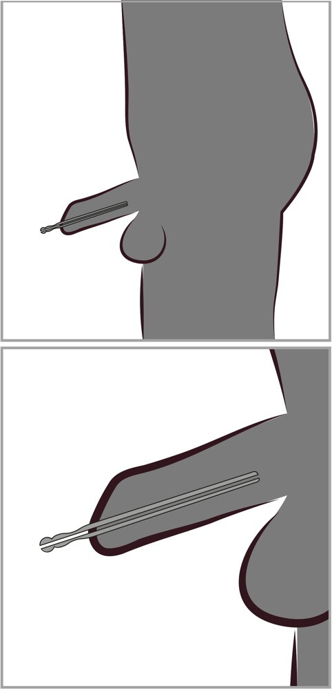 Hollow Dilator